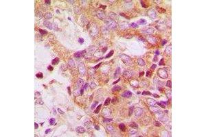 Immunohistochemical analysis of RPS13 staining in human breast cancer formalin fixed paraffin embedded tissue section. (RPS13 Antikörper)