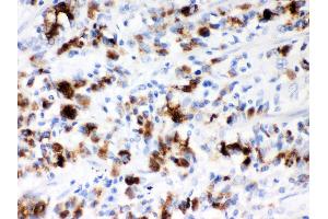 Anti- Mucin-5AC Picoband antibody, IHC(P) IHC(P): Human Gastric Cancer Tissue (MUC5AC Antikörper  (AA 4848-5030))