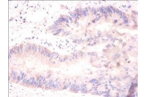 Immunohistochemistry of paraffin-embedded human colon cancer using ABIN7155377 at dilution of 1:100 (H2AFJ Antikörper  (AA 2-129))