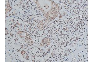 ABIN6267039 at 1/200 staining human breast cancer tissue sections by IHC-P. (Histone 3 Antikörper)