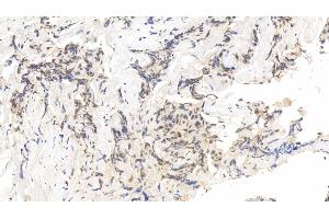 Detection of FOXP3 in Human Breast cancer Tissue using Monoclonal Antibody to Forkhead Box P3 (FOXP3)