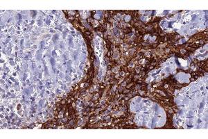 ABIN6279127 at 1/100 staining Human Head and neck cancer tissue by IHC-P. (SLC4A3 Antikörper  (N-Term))