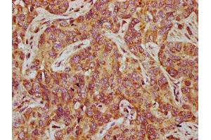 IHC image of ABIN7165837 diluted at 1:500 and staining in paraffin-embedded human liver cancer performed on a Leica BondTM system. (NTAN1 Antikörper  (AA 219-310))