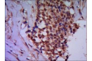 IHC of paraffin-embedded human breast cancer using anti-Protein Phosphatase 4C mouse mAb diluted 1/500-1/1000. (Protein Phosphatase 4C Antikörper)