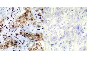 Immunohistochemical analysis of paraffin- embedded human breast carcinoma tissue using Abl1 (Ab-412) antibody (E022002). (ABL1 Antikörper)