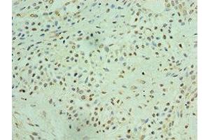 Immunohistochemistry of paraffin-embedded human breast cancer using ABIN7172050 at dilution of 1:100 (THOC1 Antikörper  (AA 428-657))