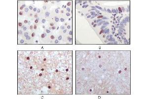 Immunohistochemical analysis of paraffin-embedded human liver carcinoma (A), recturn carcinoma (B), normal medulla tissue (C) and normal interbrain tissues (D), showing nuclear localization using Tip60 antibody with DAB staining.