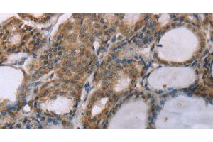 Immunohistochemistry of paraffin-embedded Human thyroid cancer using ACTN2 Polyclonal Antibody at dilution of 1:30 (ACTN2 Antikörper)
