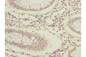 Immunohistochemistry of paraffin-embedded human colon cancer using ABIN7144631 at dilution of 1:100 (ARPIN Antikörper  (AA 1-226))