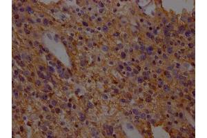 IHC image of ABIN7152226 diluted at 1:200 and staining in paraffin-embedded human glioma cancer performed on a Leica BondTM system. (SLC1A3 Antikörper  (AA 146-236))