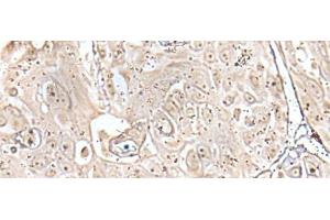 Immunohistochemistry of paraffin-embedded Human esophagus cancer tissue using VRK3 Polyclonal Antibody at dilution of 1:45(x200) (VRK3 Antikörper)