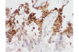 Anti-PGK1 antibody, IHC(P) IHC(P): Human Lung Cancer Tissue (PGK1 Antikörper  (Middle Region))