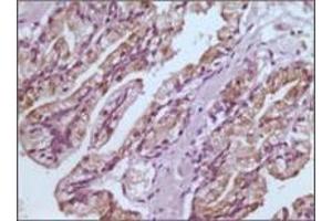 Immunohistochemical analysis of paraffin-embedded human prostate tissues using GSTP1 antibody with DAB staining. (GSTP1 Antikörper)