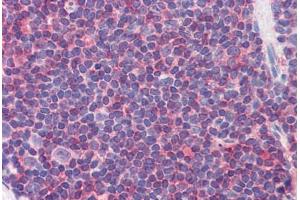 Human Colon, MALT (formalin-fixed, paraffin-embedded) stained with IL7R antibody ABIN351553 at 5 ug/ml followed by biotinylated goat anti-rabbit IgG secondary antibody ABIN481713, alkaline phosphatase-streptavidin and chromogen. (IL7R Antikörper  (pTyr449))