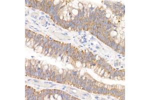 Immunohistochemistry of paraffin-embedded human colon carcinoma using GFPT1 Rabbit mAb (ABIN7267430) at dilution of 1:150 (40x lens). (GFPT1 Antikörper)