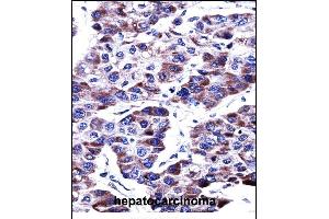 DUSP9 Antibody (C-term) ((ABIN657812 and ABIN2846780))immunohistochemistry analysis in formalin fixed and paraffin embedded human hepatocarcinoma followed by peroxidase conjugation of the secondary antibody and DAB staining.