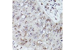 Immunohistochemistry of paraffin-embedded human esophageal cancer using GOLGB1 Rabbit pAb (ABIN7267498) at dilution of 1:100 (40x lens). (Golgin B1 (GOLGB1) Antikörper)