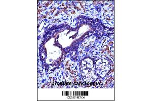 ACTG2 Antibody immunohistochemistry analysis in formalin fixed and paraffin embedded human prostate cancinoma followed by peroxidase conjugation of the secondary antibody and DAB staining. (ACTG2 Antikörper  (C-Term))