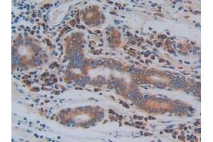 Detection of ITGb3 in Human Stomach cancer Tissue using Polyclonal Antibody to Integrin Beta 3 (ITGb3) (Integrin beta 3 Antikörper  (AA 135-377))