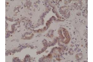 IHC testing of formalin fixed and paraffin embedded human thyroid cancer tissue with recombinant phospho-EIF2A antibody at 1:200 dilution. (Rekombinanter EIF2A Antikörper  (pSer51))