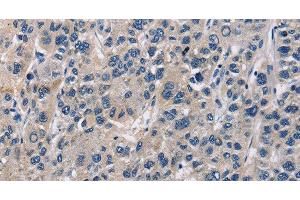 Immunohistochemistry of paraffin-embedded Human liver cancer tissue using ABI3BP Polyclonal Antibody at dilution 1:60 (ABI3BP Antikörper)