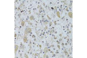 Immunohistochemistry of paraffin-embedded human liver cancer using MAP2K5 Antibody. (MAP2K5 Antikörper  (AA 1-190))