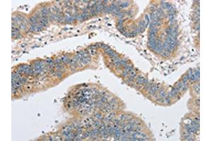 The image on the left is immunohistochemistry of paraffin-embedded Human colon cancer tissue using ABIN7128507(ARHGEF9 Antibody) at dilution 1/50, on the right is treated with fusion protein. (Arhgef9 Antikörper)
