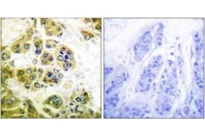 Immunohistochemistry analysis of paraffin-embedded human breast carcinoma tissue, using IKK-alpha/beta (Ab-180/181) Antibody. (IKK-alpha /IKK-beta Antikörper  (AA 141-190))