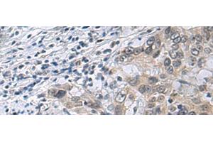 Immunohistochemistry of paraffin-embedded Human esophagus cancer tissue using IRS4 Polyclonal Antibody at dilution of 1:45(x200) (IRS4 Antikörper)