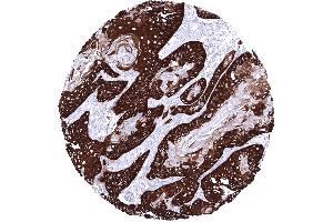 Squamous cell carcinoma of the esophagus with strong predominantly basal KRT14 immunostaining (Rekombinanter KRT14 Antikörper  (AA 350-472))