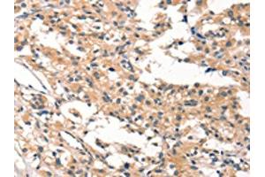 The image on the left is immunohistochemistry of paraffin-embedded Human thyroid cancer tissue using ABIN7190422(CYP46A1 Antibody) at dilution 1/15, on the right is treated with synthetic peptide. (CYP46A1 Antikörper)