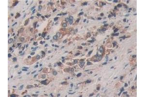 Detection of PDIA4 in Human Prostate cancer Tissue using Polyclonal Antibody to Protein Disulfide Isomerase A4 (PDIA4)