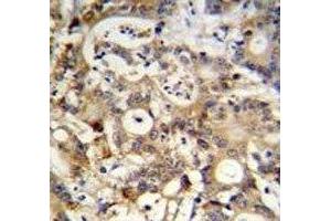 SP1 antibody immunohistochemistry analysis in formalin fixed and paraffin embedded human colon carcinoma. (SP1 Antikörper  (AA 677-707))