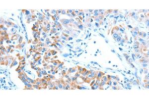 Immunohistochemistry of paraffin-embedded Human lung cancer tissue using ALDH5A1 Polyclonal Antibody at dilution 1:60 (ALDH5A1 Antikörper)