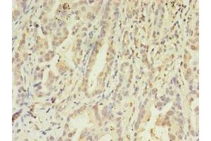Immunohistochemistry of paraffin-embedded human lung cancer using ABIN7152867 at dilution of 1:100 (FGL2 Antikörper  (AA 24-439))