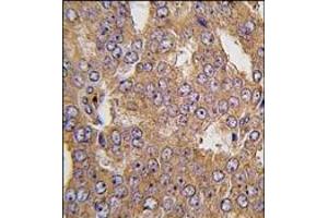 Formalin-fixed and paraffin-embedded human prostata carcinoma tissue reacted with NARS2 antibody (C-term), which was peroxidase-conjugated to the secondary antibody, followed by DAB staining.