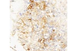Immunohistochemistry analysis of paraffin-embedded human endometrial cancer using INSR (ABIN7074298) at dilution of 1: 6000 (ISR-alpha Antikörper)