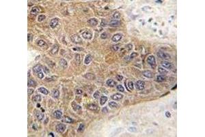 IHC analysis of FFPE human hepatocarcinoma tissue stained with STUB1 antibody (STUB1 Antikörper  (AA 203-231))