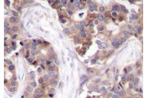 Immunohistochemistry of paraffin-embedded Human breast carcinoma using Phospho-STMN1(S25) Polyclonal Antibody (Stathmin 1 Antikörper  (pSer25))