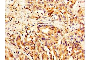 IHC image of ABIN7171484 diluted at 1:400 and staining in paraffin-embedded human liver cancer performed on a Leica BondTM system. (TLN1 Antikörper  (AA 92-399))