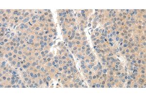 Immunohistochemistry of paraffin-embedded Human liver cancer tissue using SLC20A1 Polyclonal Antibody at dilution 1:40 (SLC20A1 Antikörper)