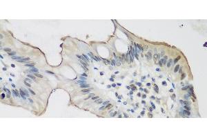 Immunohistochemistry of paraffin-embedded Human stomach cancer using ALOX15 Polyclonal Antibody at dilution of 1:200 (40x lens). (ALOX15 Antikörper)