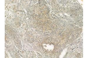 ABIN6266254 and ABIN6277415 at 1/100 staining human cervical carcinoma by IHC-P.