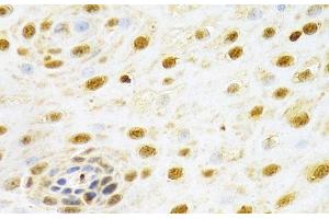Immunohistochemistry of paraffin-embedded Human esophageal cancer using RUNX1 Polyclonal Antibody at dilution of 1:100 (40x lens). (RUNX1 Antikörper)