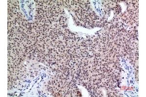 Immunohistochemistry (IHC) analysis of paraffin-embedded Human Mammary Cancer, antibody was diluted at 1:100. (P57 (Ser24) Antikörper)