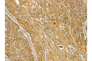 Mitofusin 2 Mouse Monoclonal Antibody at 1/100 staining human esophageal cancer and adjacent non-tumor tissue by IHC-P.