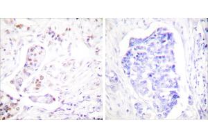 Peptide - +Immunohistochemical analysis of paraffin-embedded human breast carcinoma tissue using Cyclin A1 antibody (#C0166). (Cyclin A1 Antikörper)