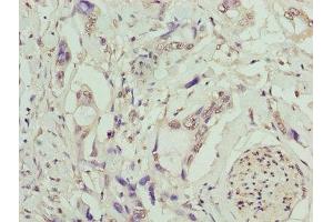 Immunohistochemistry of paraffin-embedded human pancreatic cancer using ABIN7173237 at dilution of 1:100 (TMEM53 Antikörper  (AA 1-170))