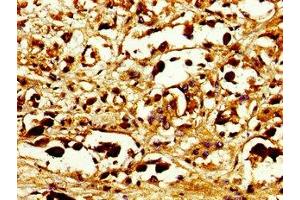 Immunohistochemistry of paraffin-embedded human melanoma using ABIN7146085 at dilution of 1: 100 (CD27 Antikörper  (AA 229-312))