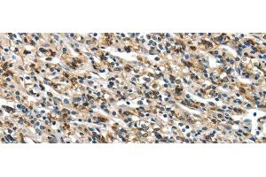 Immunohistochemistry of paraffin-embedded Human prostate cancer using GLP2R Polyclonal Antibody at dilution of 1/30 (GLP2R Antikörper)